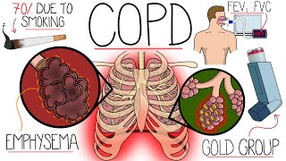 Understanding Chronic Obstructive Pulmonary Disease COPD Explained Clearly [upl. by Helmut]