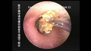 Review and cleaning of two types of cholesteatoma [upl. by Nesmat]