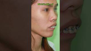 Buck teeth braces braces orthodontist dental dentistry niengrang [upl. by Gnues]