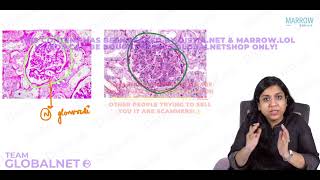 NEPHRITIC SYNDROME By Dr Illa jain khandelwal Pathology by Marrow Video Lecture [upl. by Nnahtur]