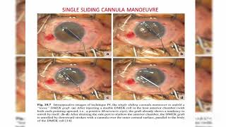 Endothelial keratoplasty DMEK DSEK DLEK PDEK Ophthalmology [upl. by Noirrad916]