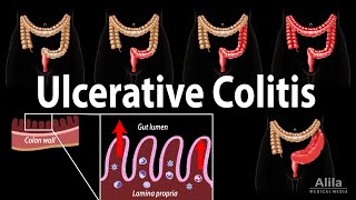 Ulcerative Colitis Pathophysiology Symptoms Risk factors Diagnosis and Treatments Animation [upl. by Norma]