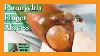 Paronychia Fingernail Abscess Infection Treatment  Auburn Medical Group [upl. by Ellebanna]