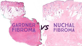 Gardner fibroma vs Nuchaltype fibroma Emory 78 Gardner syndrome familial adenomatous polyposis [upl. by Ary963]