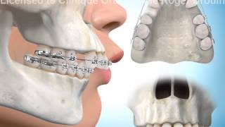 Extractions de dents pour correction surplomb horizontal [upl. by Ahsimot]