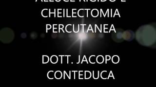 cheilectomia percutanea per alluce rigido Dott Jacopo Conteduca [upl. by Niko]