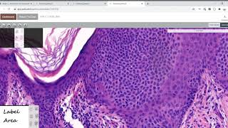 Seborrheic Keratosis [upl. by Nodal]