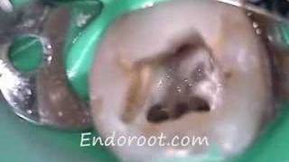 Retratamiento de endodoncia con 3 conductos mesiales [upl. by Boff]