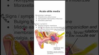 Acute otitis media [upl. by Melia]