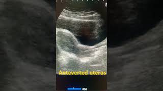 Anteverted uterus ultrasound shortfeed medical uterus pelvic pelvis study shortsviral short [upl. by Euqirrne]