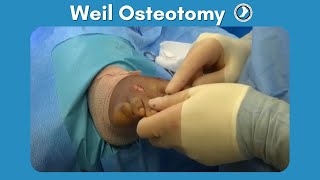 Weil Osteotomy Performed by Dr Paul Steinke [upl. by Htebezile]