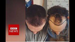 Hair loss Fighting against my receding hairline  BBC News [upl. by Euqinimod]