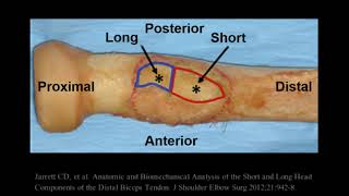 Distal Biceps Tendon Anatomic Repair [upl. by Sitruc]