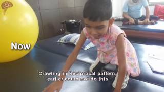 Spastic Quadriplegic Cerebral Palsy Treatment Results  Quick Look  No 3413 [upl. by Sile]