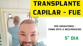 TRANSPLANTE CAPILAR  FUE 5° DIA PÓS OPERATÓRIO [upl. by Thaddeus]