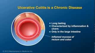 What is Ulcerative Colitis [upl. by Gennaro]