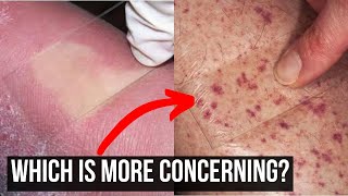 Why Knowing If A Rash Blanches Is Important [upl. by Aletse]