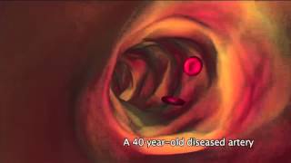 What is atherosclerosis [upl. by Renruojos]