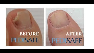 Black Toenail how to fix broken toenail safely [upl. by Una133]