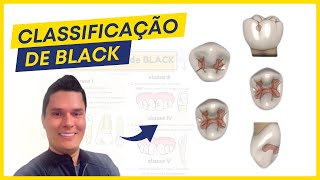 Classificações de Black  Dentística Guia Completo [upl. by Favin]