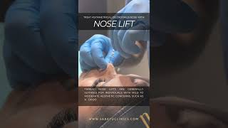 Nose Lift the solution to your asymmetrical or crooked nose [upl. by Pages]