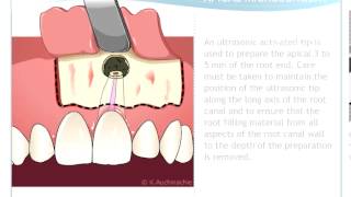 Endodontic Microsurgery [upl. by Asserac]