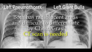 Pneumothorax vs Bulla in Chest X ray [upl. by Noll552]