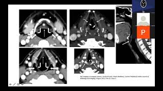 Role of PET CT In Larynx and Hypopharynx Carcinoma BY DR SAYAK CHOUDHARY [upl. by Aronos]