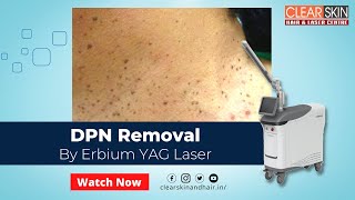 DPN Removal treatment by Erbium YAG Laser  How To Get Rid Of Dermatosis Papulosa Nigra DrKailash [upl. by Trula]