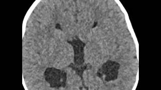 Heterotopic Gray Matter [upl. by Massie]