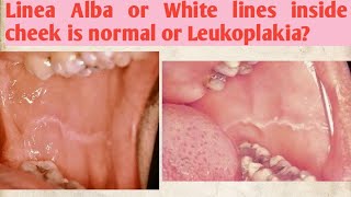 Linea Alba or White lines inside cheek is normal or Leukoplakia [upl. by Antonino799]