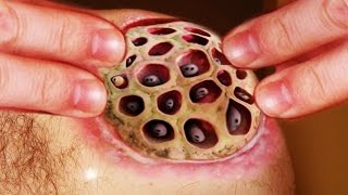 Trypophobia Is It Real Extended Edition [upl. by Eneli497]