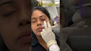 Eye Filler Treatment Watch the Full Process with Dr Anupriya Goel 🌟 eyecare surgerytips [upl. by Urias]