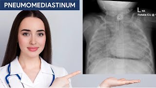 Pneumomediastinum in Chest X ray [upl. by Nihhi]