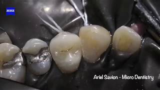 Restoring Teeth without Root Canal Treatment Effective Caries Removal and Crown Restoration [upl. by Novad]