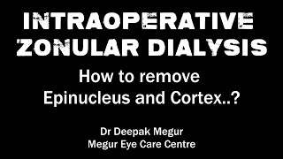 Intraoperative Zonular Dialysis How to remove Epinucleus and Cortex  Dr Deepak Megur [upl. by Wadesworth]