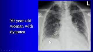 14b ILD P 2 Lower lung interstitial Disease [upl. by Peers]