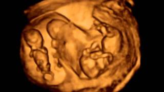 3D ultrasound Dichorionic triamniotic triplets 12 weeks [upl. by Enerod]