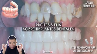 Puente sobre dientes  Prótesis Fija [upl. by Dalury]