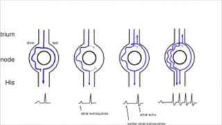 AVNRT AV nodal reentrant tachycardia [upl. by Ydoow]