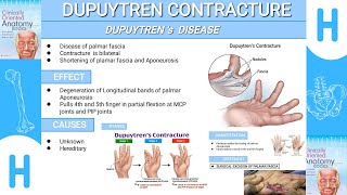 Dupuytrens ContractureFull description Dupuytrendisease [upl. by Placido812]