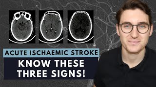 How to read a CT brain scan Acute ischaemic stroke for beginners [upl. by Ecinhoj]