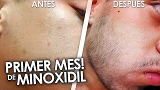 MI PRIMER MES USANDO MINOXIDIL [upl. by Akinahc916]