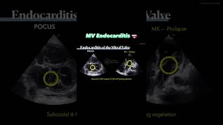 Mitral valve endocarditis 🫀 [upl. by Reinaldos]