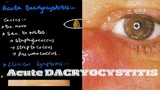 Acute Dacryocystitis  lacrimal system [upl. by Fabri]