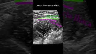 Fascia Iliaca Plane Block ultrasound nerveblock anatomy [upl. by Eninahpets867]