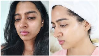 How I got Rid of Skin Pigmentation amp Uneven Skin Tone [upl. by Elleiram]