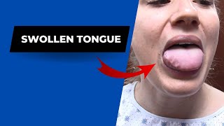 Swollen tongue HELPED by Dr Suh Specific Chiropractic NYC [upl. by Sitnerp]