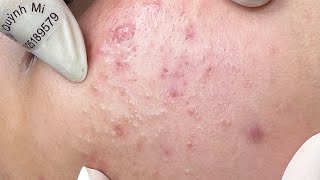 ACNE TREATMENT VU QUYNH MI Acne On Boys Chin 2024 [upl. by Alrad]