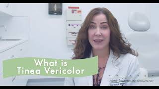 Tinea Versicolor How to Treat [upl. by Ahsinelg852]